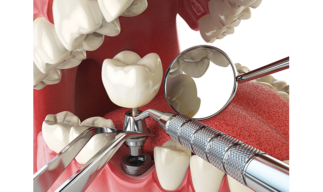 How can I get money back from failed dental implants?