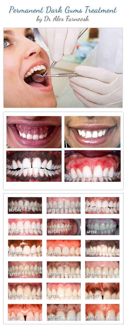 How can I lighten my dark gums?