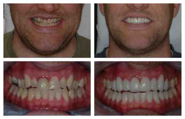 How can I make my dental implant heal faster?