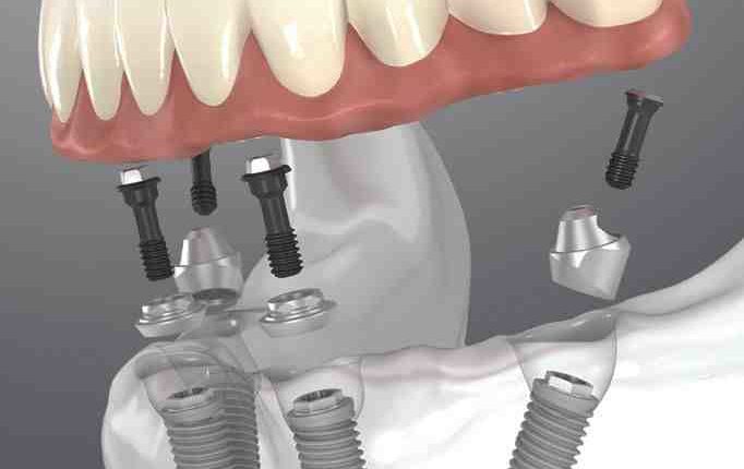 How dental implants work