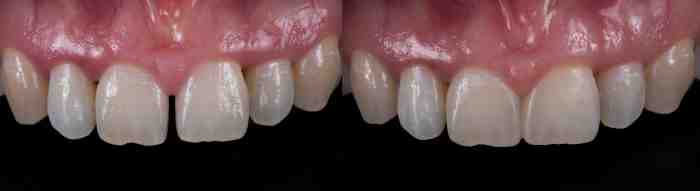 How do I get a cosmetic dental grant?