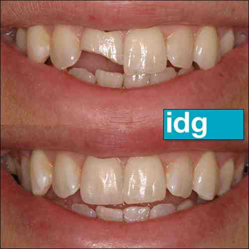 How do I get a cosmetic dental grant?