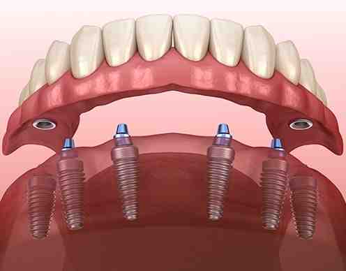 How do you clean all on four dental implants?