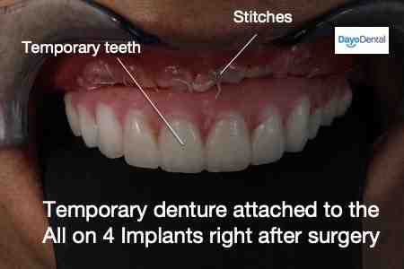How do you clean full dental implants?