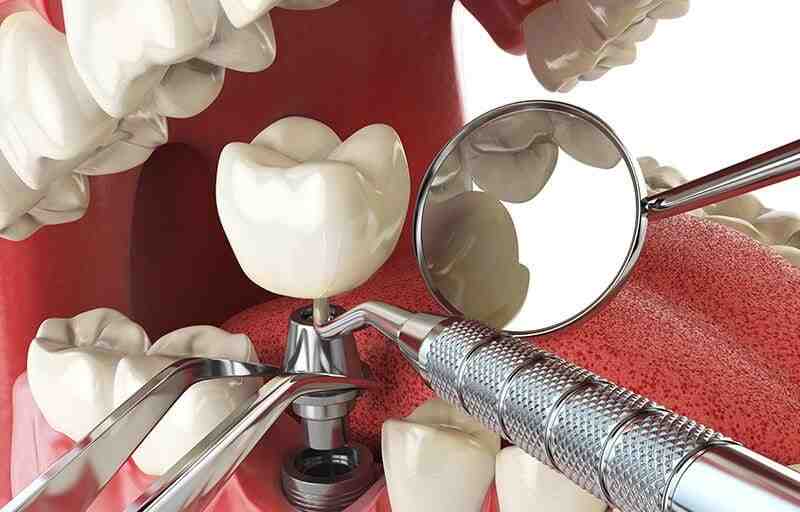 How do you pay for dental implants?