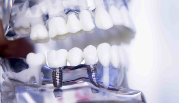 How does dental implants work