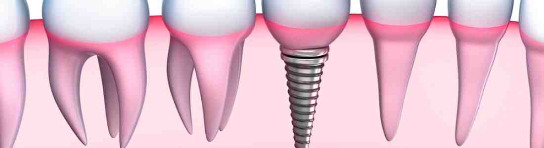 How long after dental implants can I eat normally?