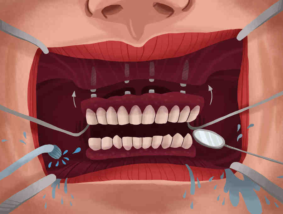 How long do all on 4 implants last?