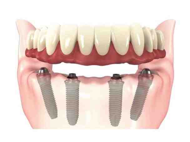 How long do dental implants last?
