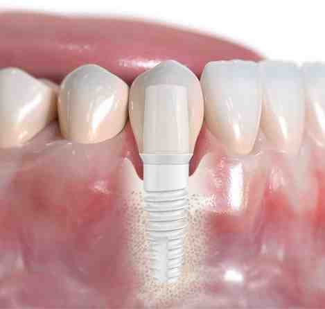 How long do dental implants last?