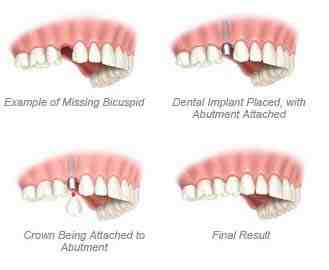 How long do dental implants last?