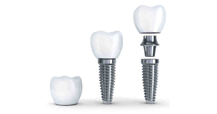 How long do dental implants last?