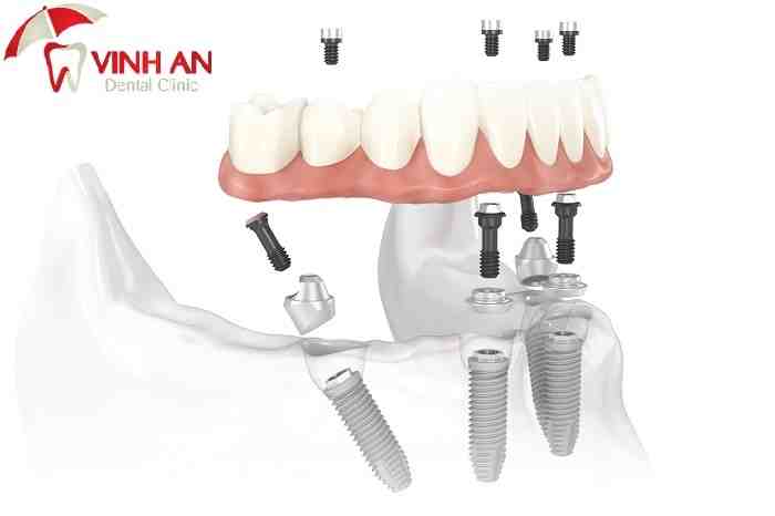 How long do dental implants last?