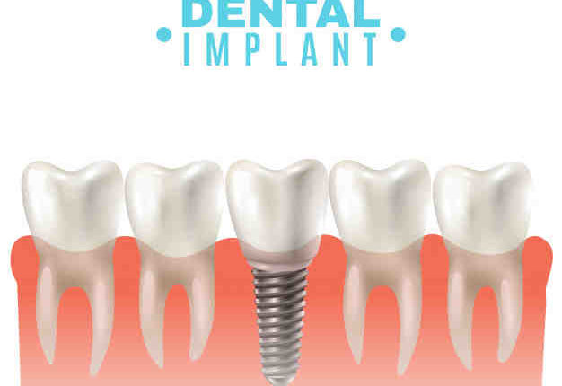 How long do dental implants take to heal