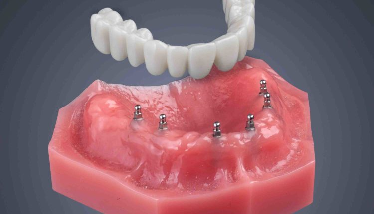How long do mini dental implants last