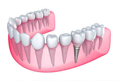 How long do mini dental implants last?