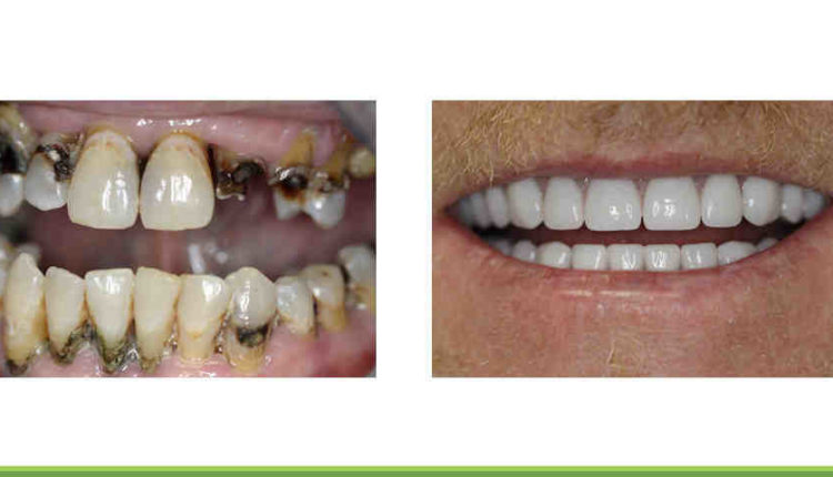 How long does a dental implant last