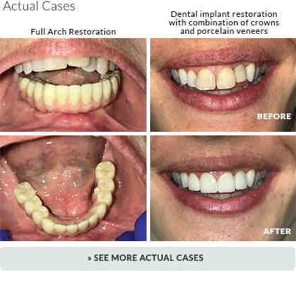 How long does a dental implant procedure take?