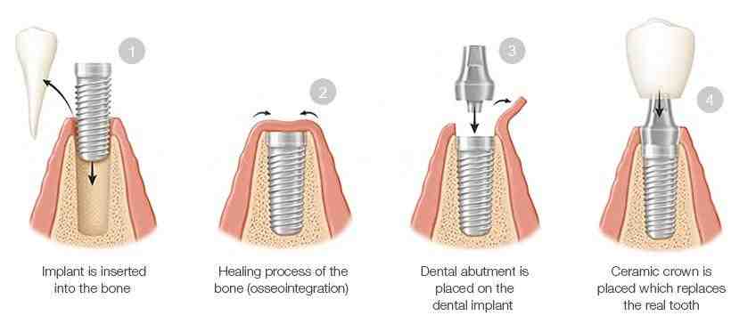 How long does a dental implant procedure take?
