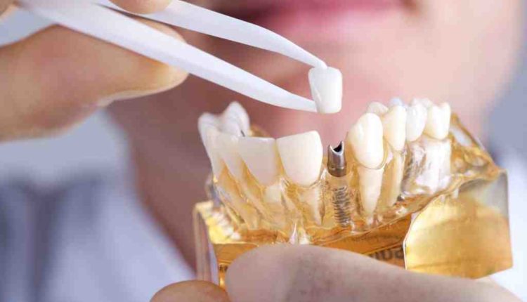 How long does a dental implant procedure take