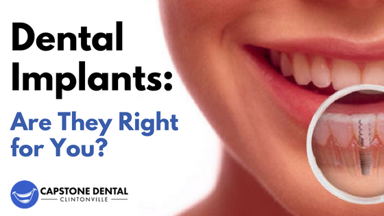How long does a dental implant procedure take?