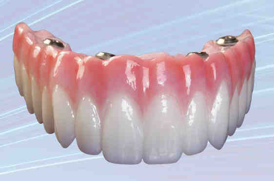 How long does a dental implant take from start to finish?