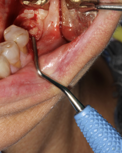 How long does a dental implant take from start to finish?