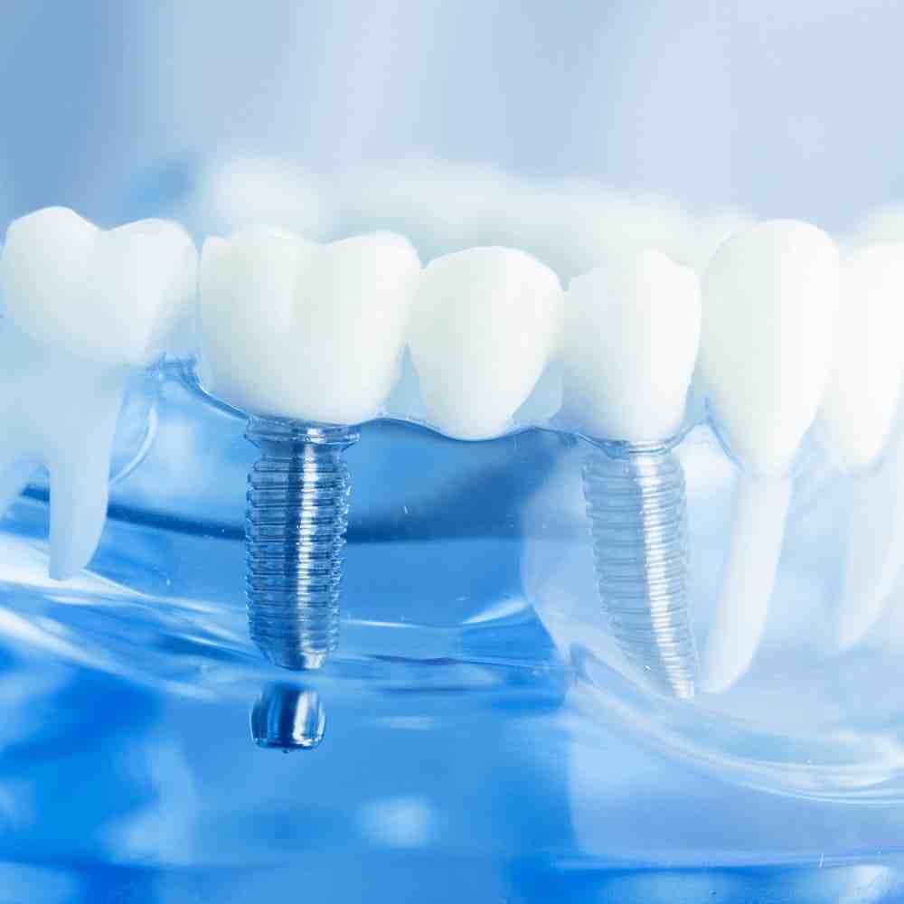 How long does it take for a dental implant to Osseointegrate to the bone?