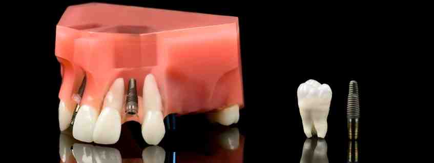 How long does it take for dental implant to fuse to bone?