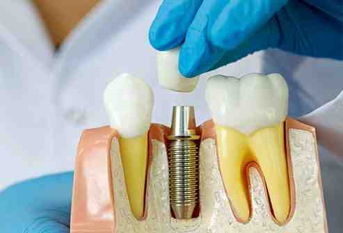 How long does it take to get an implant tooth?