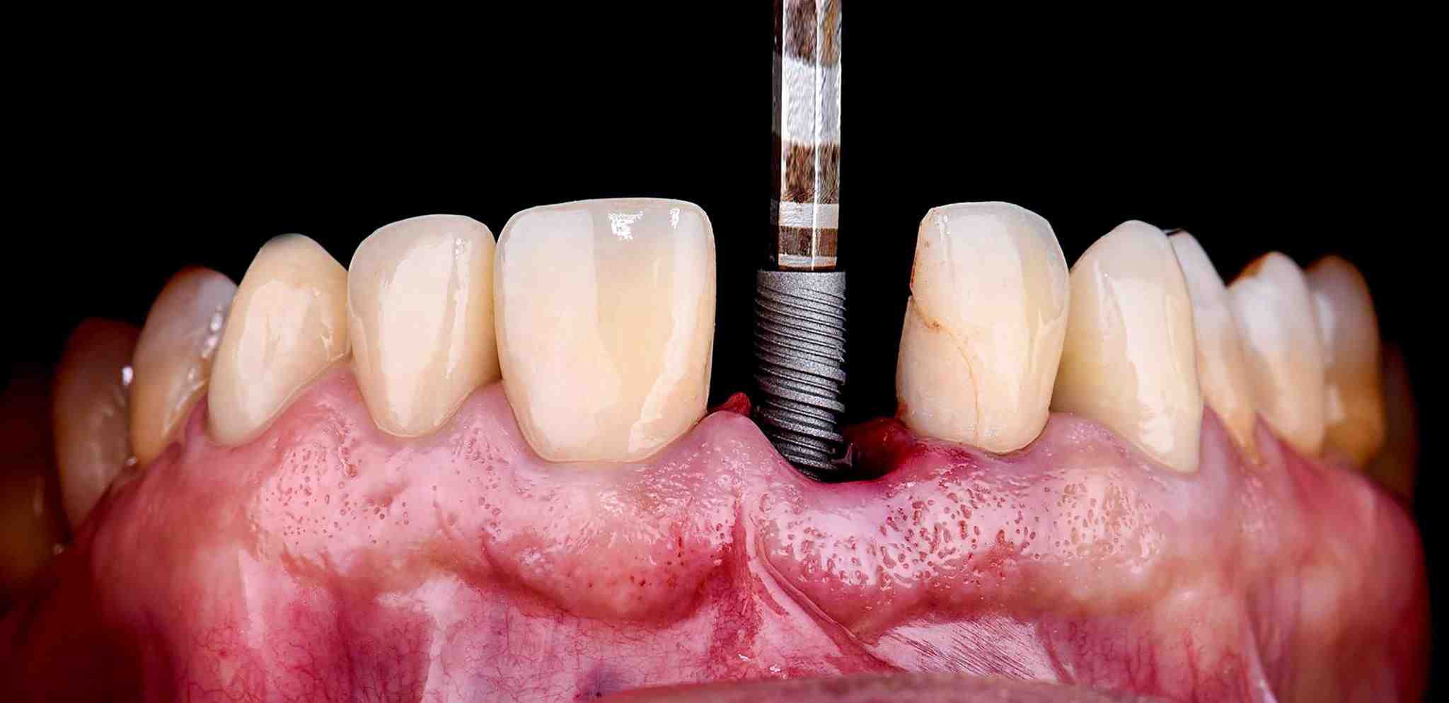 How long does it take to get dental implants - Dental News Network