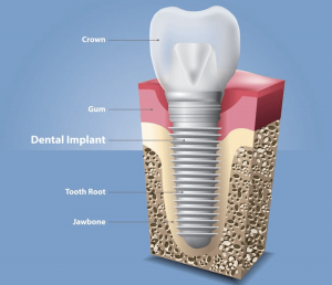 How long does the pain last after a dental implant?