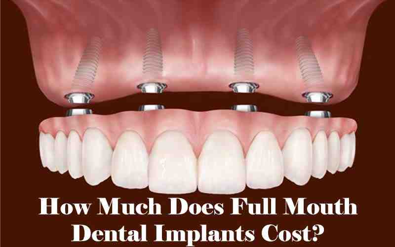 How many implants are needed for full mouth?