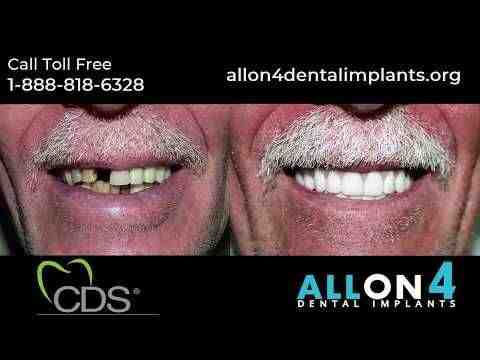 How many implants are needed for full mouth?