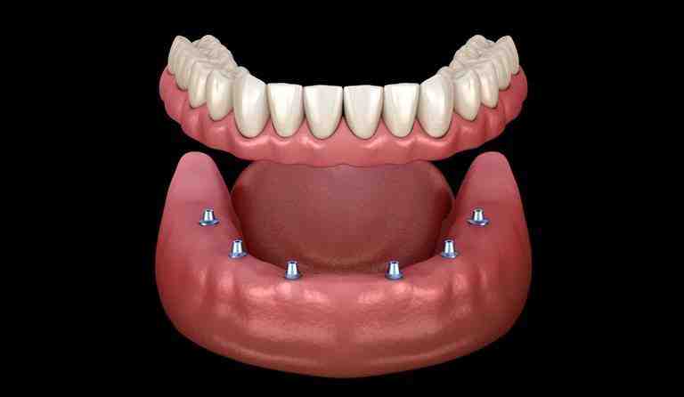 How many types of teeth implants are there?