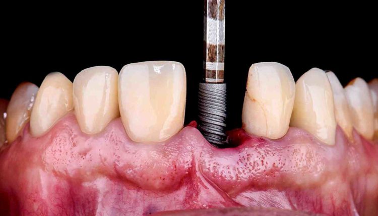 How much are dental implants