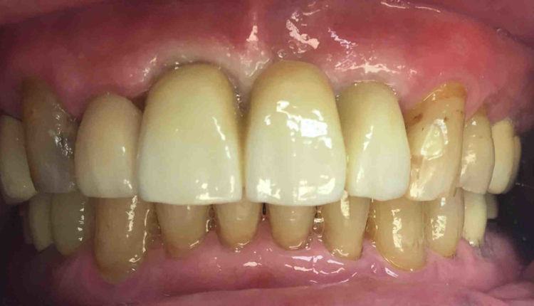 How much are dental implants?