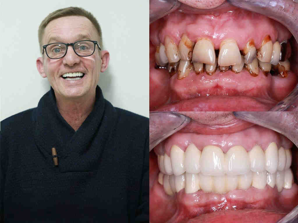 How much do dental implants cost in mexico Dental News Network