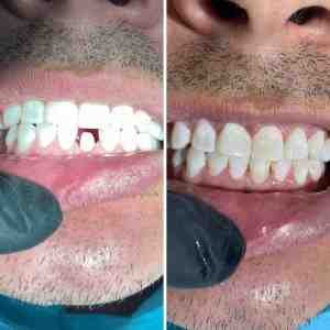 How much are dental implants in Tijuana?