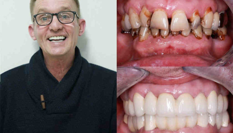 How much are dental implants in mexico