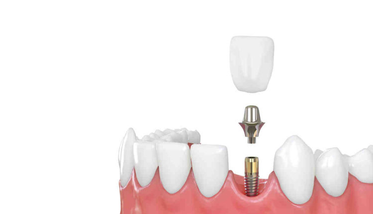 How much are dental implants per tooth