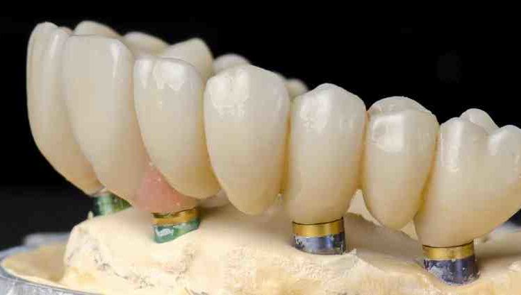 How much are full dental implants