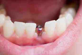 How much are the cheapest dental implants?