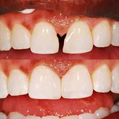 How much do cosmetic fillings cost?