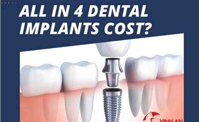 How much do dental implants cost?