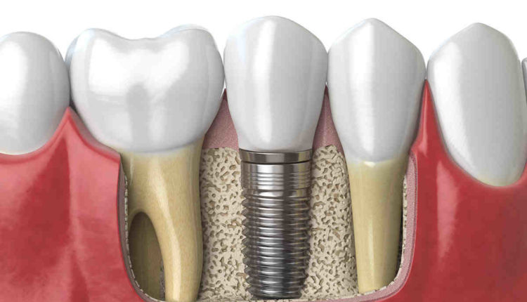 How much do dental implants cost