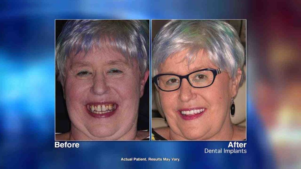 How much do dental implants cost at clear choice Dental News Network