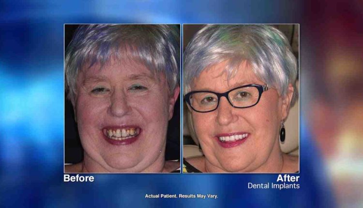 How much do dental implants cost at clear choice