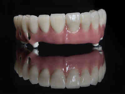 How much do dental implants cost in 2020?
