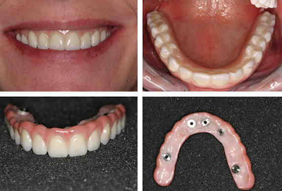 How much do dental implants cost in 2020?